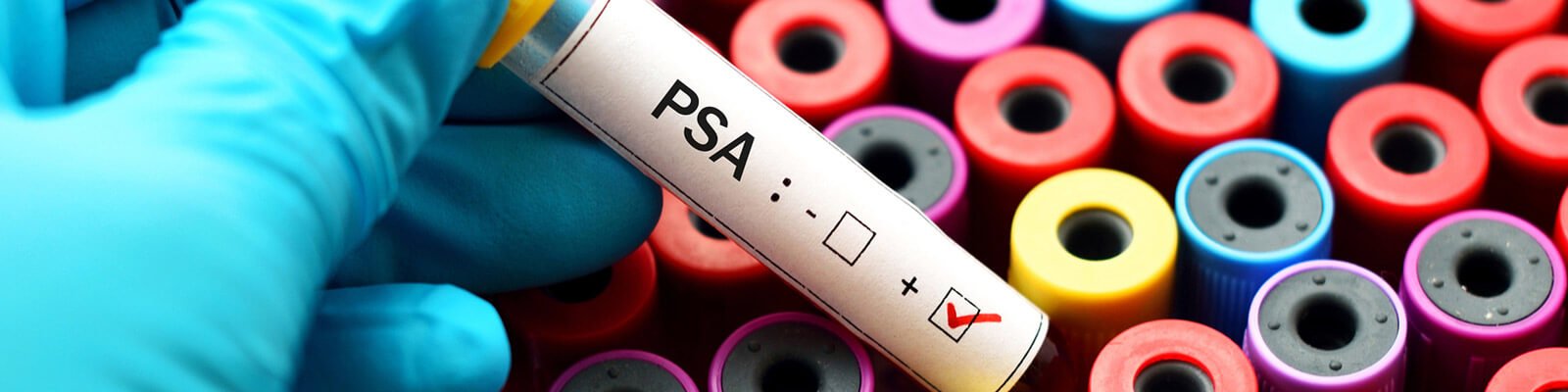 Doctor Answers: What is a PSA Test and What Does It Detect?