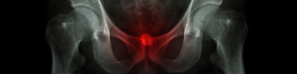 Bladder Stones in Men