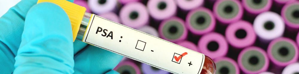 A Guide to Prostate Cancer Screening