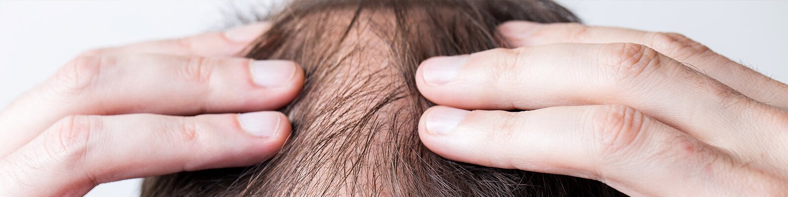 Male Pattern Baldness: Causes, Symptoms, and Treatments