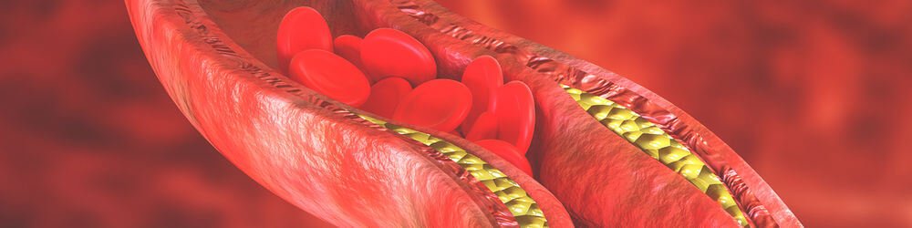 Coronary Artery Disease: Risk Factors, Symptoms, and Treatment