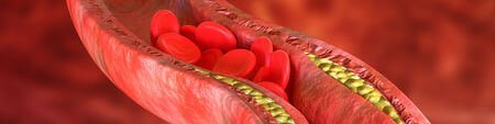 About Peripheral Artery Disease (PAD)