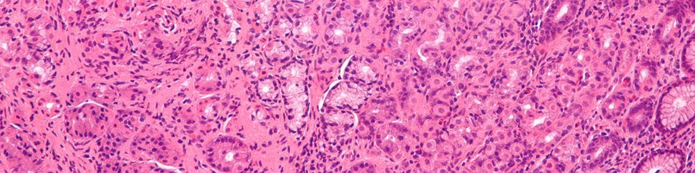 Doctor Answers: What Is Radiation Cystitis?
