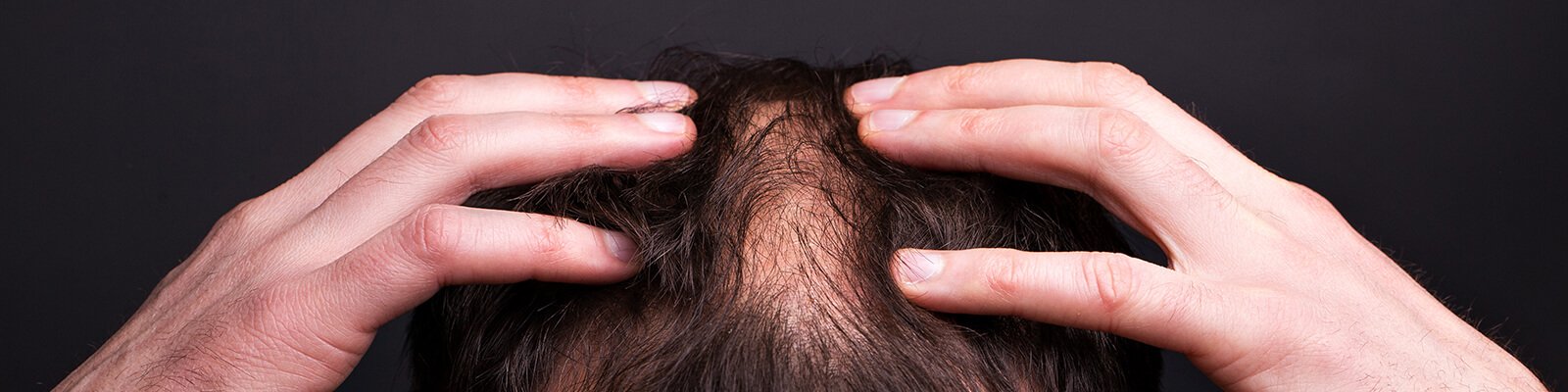 DHT Hair Loss: Causes & Treatment for Thinning Hair