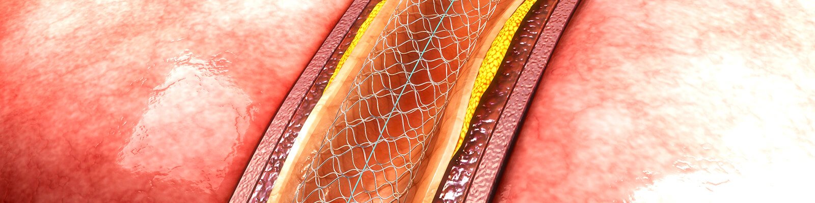 Treatment Options for BPH: What Is a Prostatic Stent?