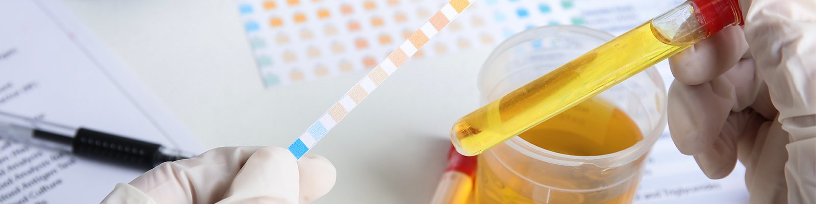 What Causes Glycosuria?