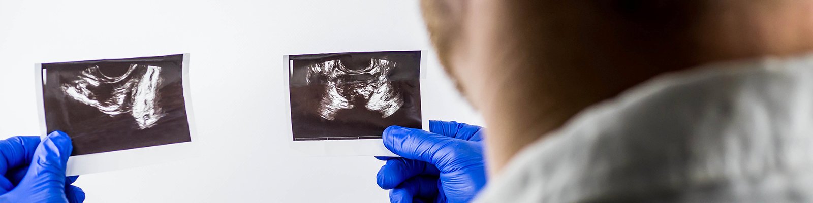 Doctor Answers: Prostatitis vs Prostate Cancer: What’s the Difference?