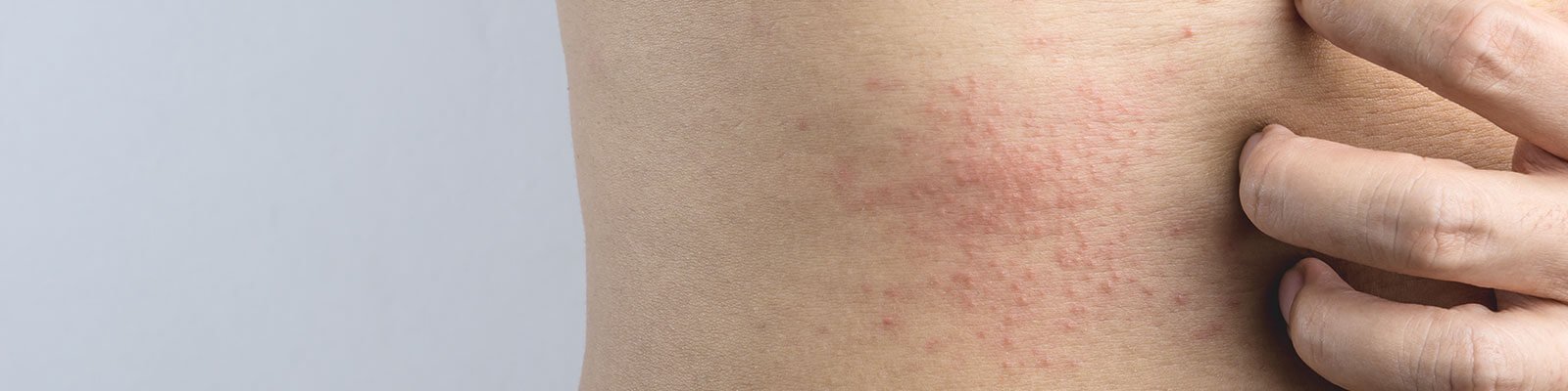 Are Skin Tags a Sign of Diabetes?