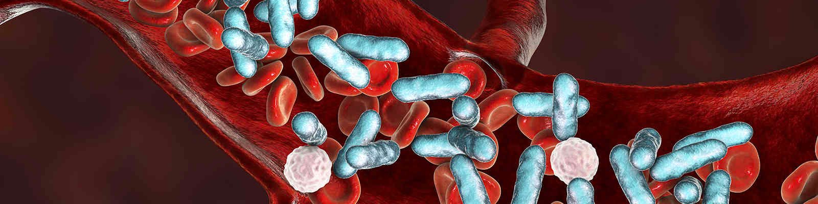 Warning Signs Of Sepsis and Septic Shock Everyone Should Know
