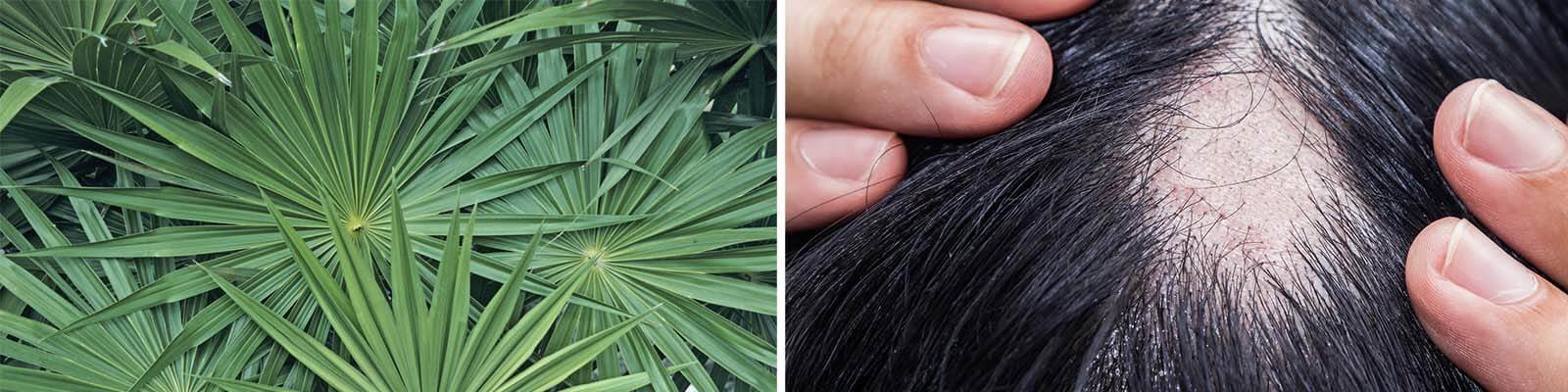 Saw Palmetto vs Finasteride: Which Is Better?