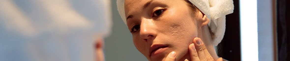15 Ways To Get Rid Of Acne Scars