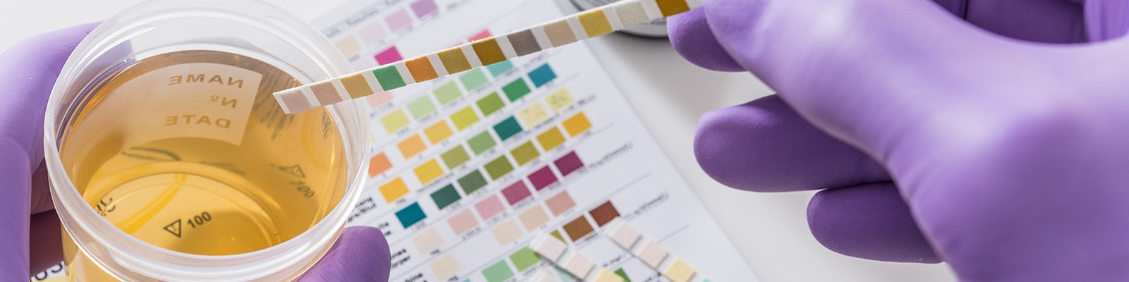 Leukocytes In Urine: Causes, Signs, Treatment