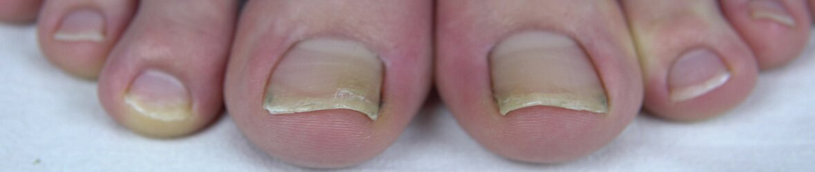 Is Diabetes Causing Your Yellow Toenails and Foot Fungus?