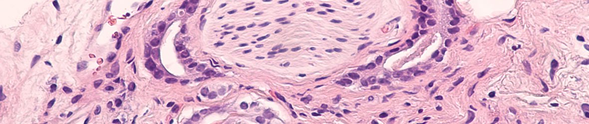 Can Perineural Invasion in Prostate Cancer Be Treated?