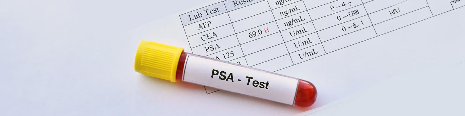 New Guidelines On Prostate Cancer Screening For Black Men